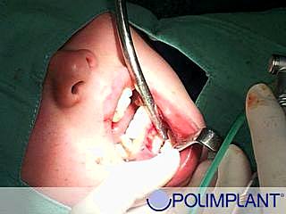szkolenie implantologiczne